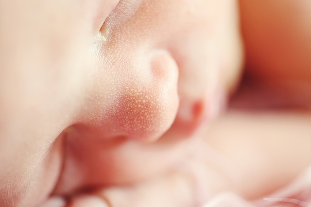 新生児の光線療法後、リバウンドする子どものリスク因子は？