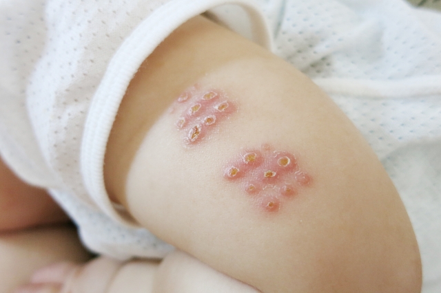 新生児期のBCG接種は、その後のアレルギー発症に影響するか？：ランダム化比較試験