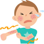 アトピー性皮膚炎によるじくじくした湿疹に抗生剤を併用すると、より早く改善する？