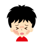 自閉症スペクトラム障害は、アレルギーと関連があるかもしれない