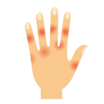 手湿疹の治療は、ステロイド外用1日2回よりステロイド外用1回＋保湿1回の方が効果的