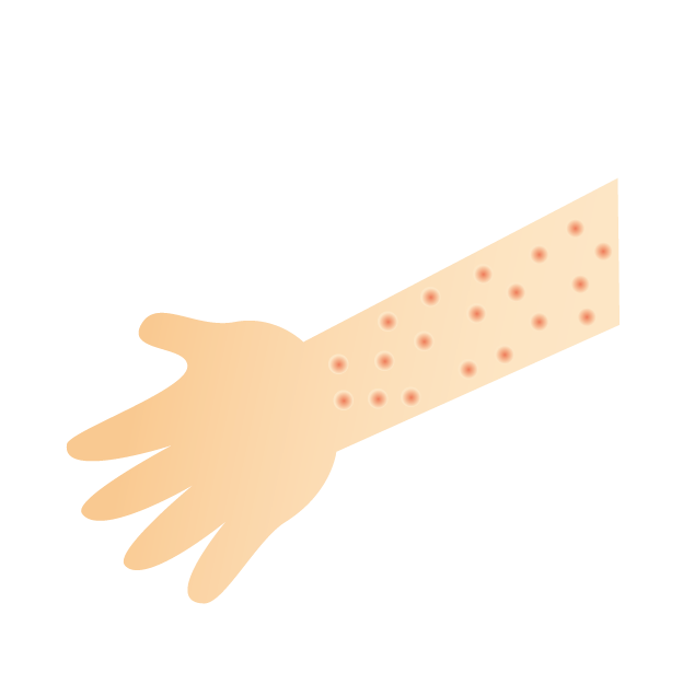 アトピー性皮膚炎は、慢性蕁麻疹の原因になるかもしれない