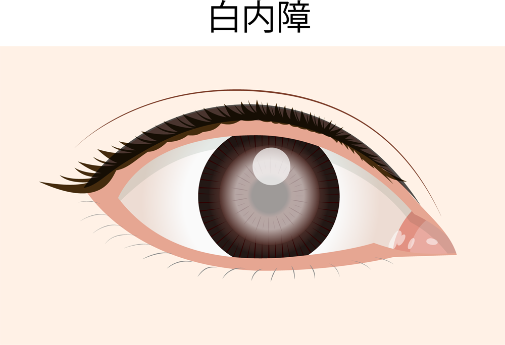 まぶたや眼の周囲にステロイドを使用すると、白内障や緑内障のリスクになるか？