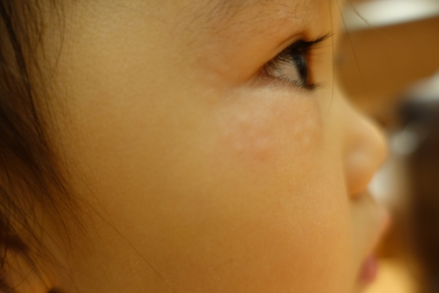 乳幼児期アトピー性皮膚炎に対するタクロリムス軟膏とステロイド外用薬の1年間の使用を比較すると？