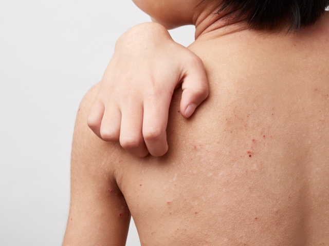 オマリズマブ（商品名ゾレア）は、小児の重症アトピー性皮膚炎に有効か？
