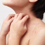 新規PDE4阻害剤（ジファミラスト）軟膏は、小児のアトピー性皮膚炎に有効か？