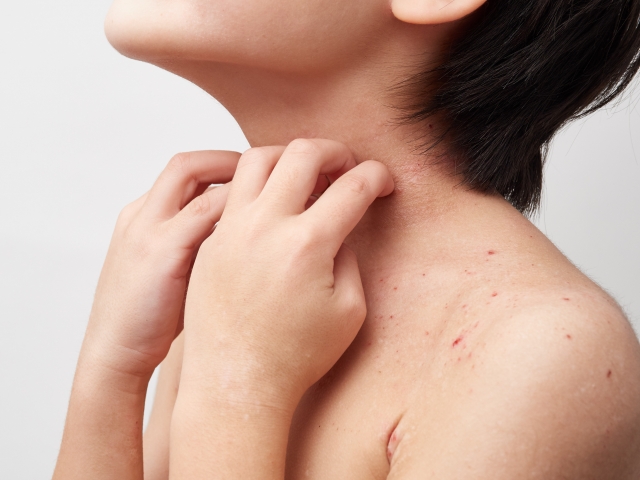 新規PDE4阻害剤（ジファミラスト）軟膏は、小児のアトピー性皮膚炎に有効か？