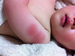 川崎病の流行は、特定の感染症の流行と関連しているかもしれない