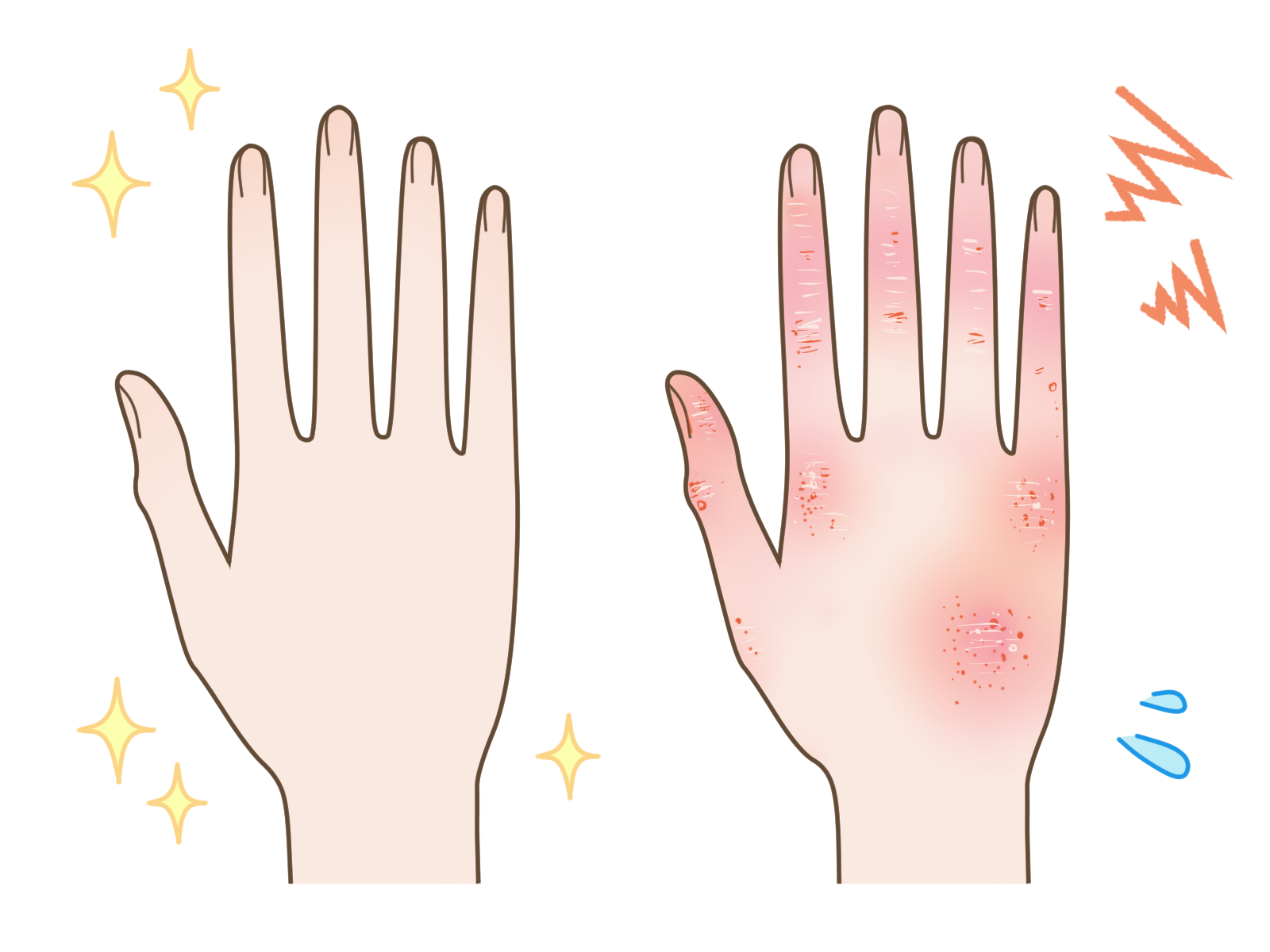 手湿疹に対するデルゴシチニブ軟膏の効果を、どのように評価する？