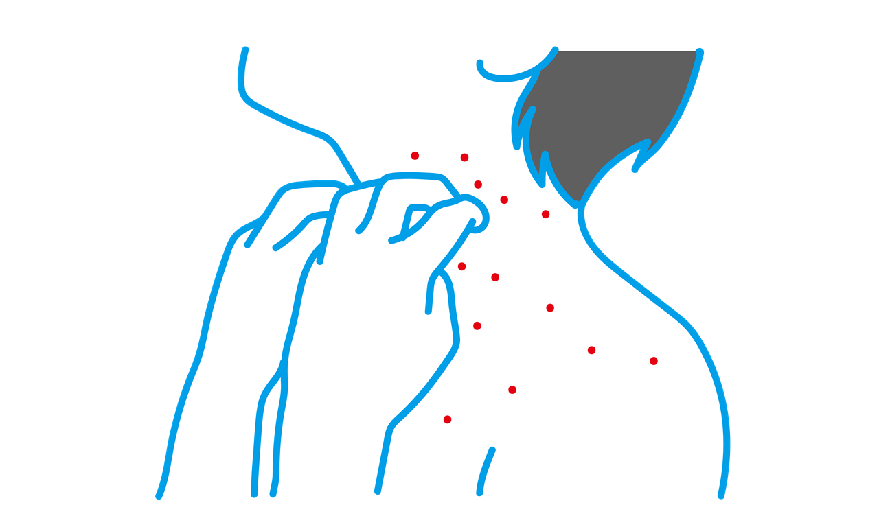 マラセチアは、セラミドを分解しアトピー性皮膚炎の頭頚部の湿疹を悪化させる？