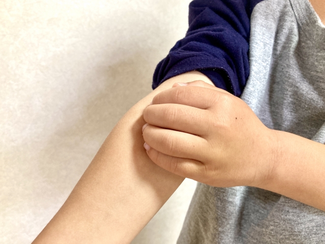 デュピルマブは、アトピー性皮膚炎のある5歳未満の子どもの感染症を減らす？