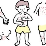 デュピルマブを中止後に、アトピー性皮膚炎の症状はどれくらい維持される？