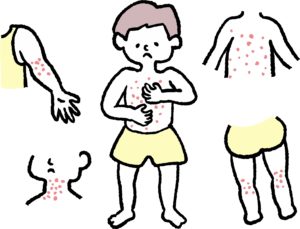 デュピルマブを中止後に、アトピー性皮膚炎の症状はどれくらい維持される？